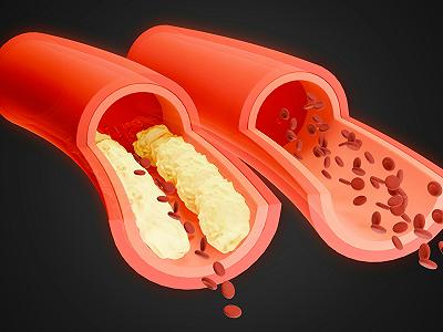 Cholesterol w prostych słowach: czym różni się „dobry” od „złego” i dlaczego warto to wiedzieć?